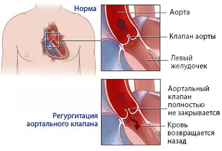 Порок сердца