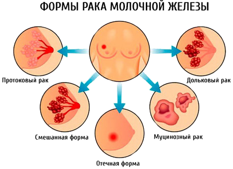 Разновидности рака молочной железы