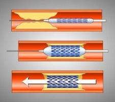стентирование сердца