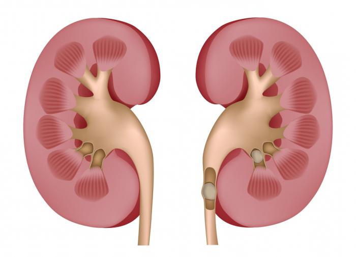 выход камней из почек