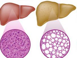 фиброз печени 1 степени, лечение