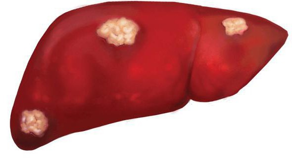 рак печени с метастазами сколько живут