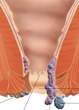 боль в заднем проходе