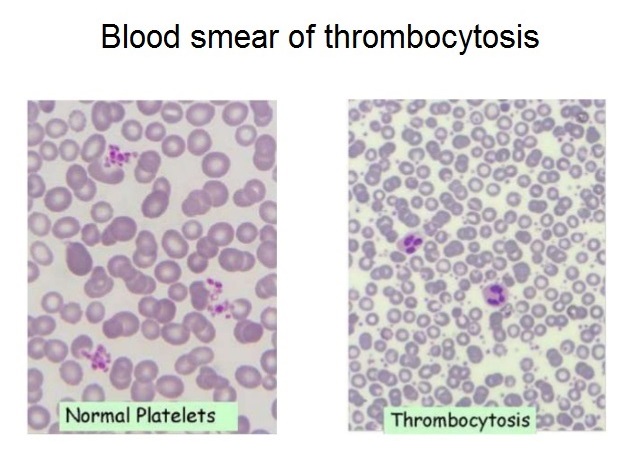 elevated platelet count