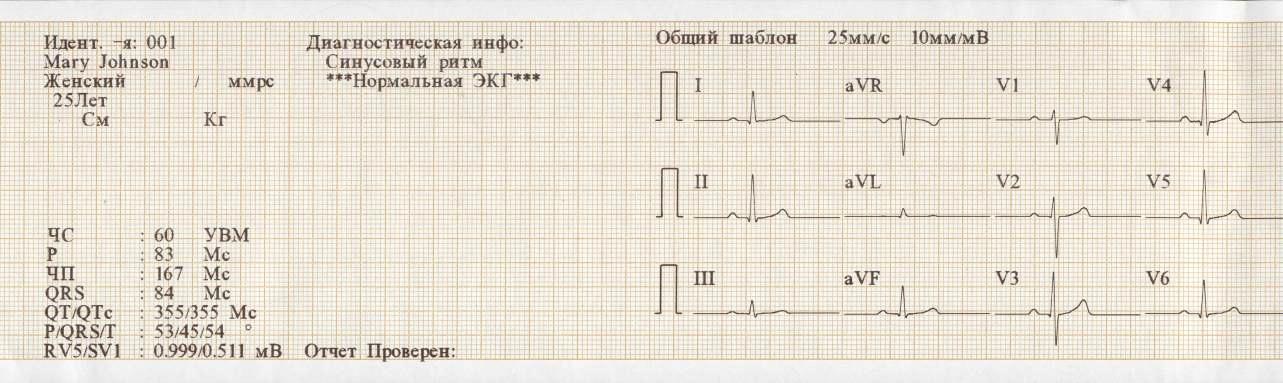Экг сочи. 10мм/МВ 50мм/с ЭКГ фильтр изолинии. Нормальная ЭКГ во всех отведениях 50мм. ЭКГ норма расшифровка кардиограммы. Кардиограмма сердца здорового человека и больного человека.