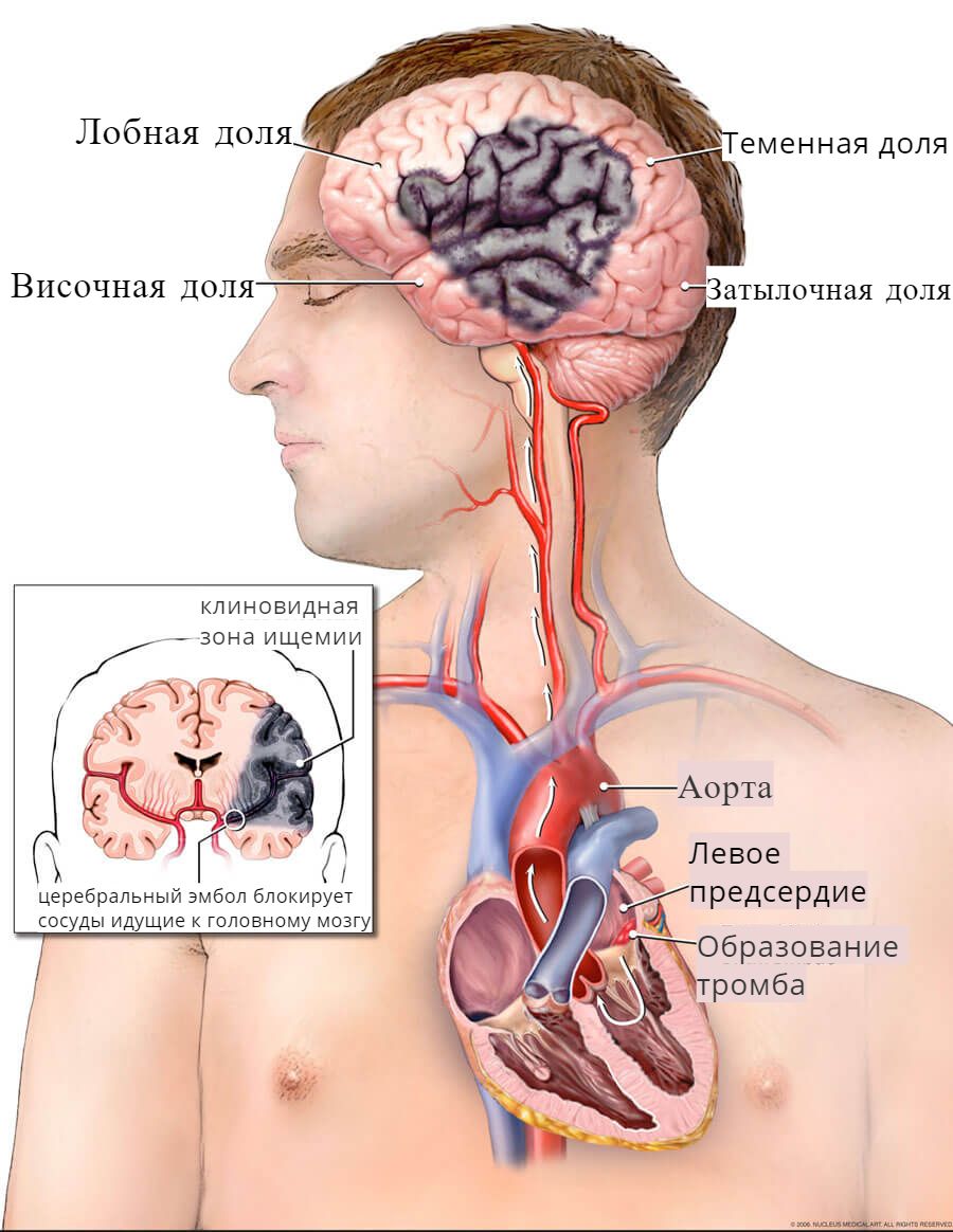 инсульт при мерцательной аритмии