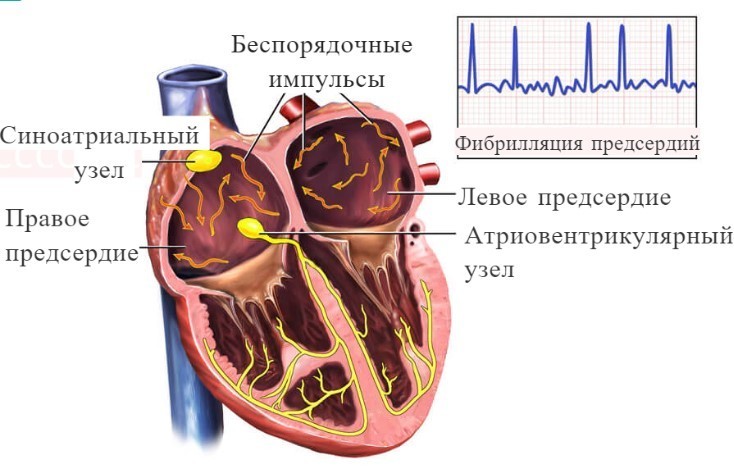 Мерцательная аритмия