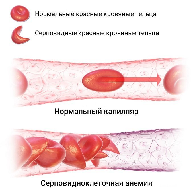 При серповидно-клеточной анемии показатель MCV может быть недостоверным, поэтому важное диагностическое значение имеет совместное определение RDW и MCV