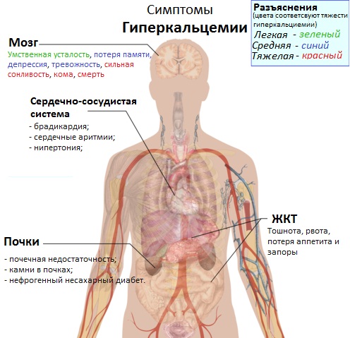 Симптомы гиперкальцемии