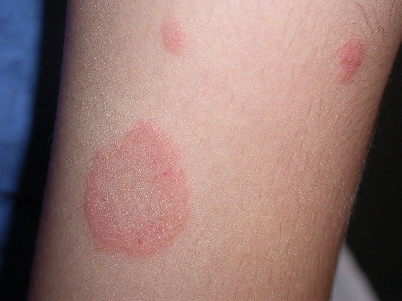 Аллергия со стороны кожных покровов