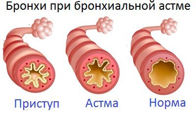 Бронхи в норме и при бронхиальной астме