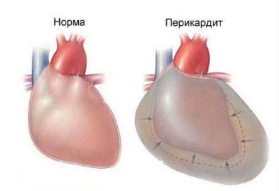 Поясница может болеть от сердца