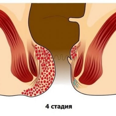 Четвёртая стадия геморроя Четвёртая стадия
