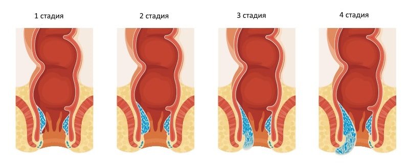 4 стадии геморроя Стадии патологического процесса