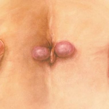 Третья стадия геморроя Третья стадия