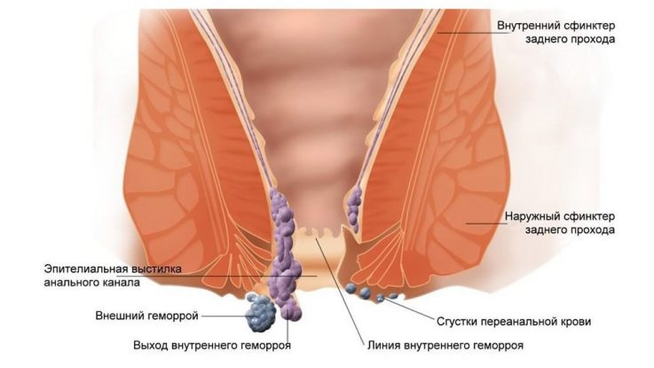 Что такое геморроидальный узел