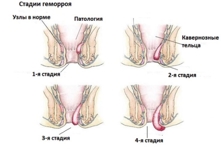 Геморрой во время беременности 