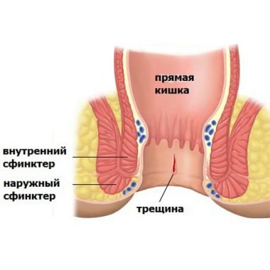 Анальные трещины в прямой кишке