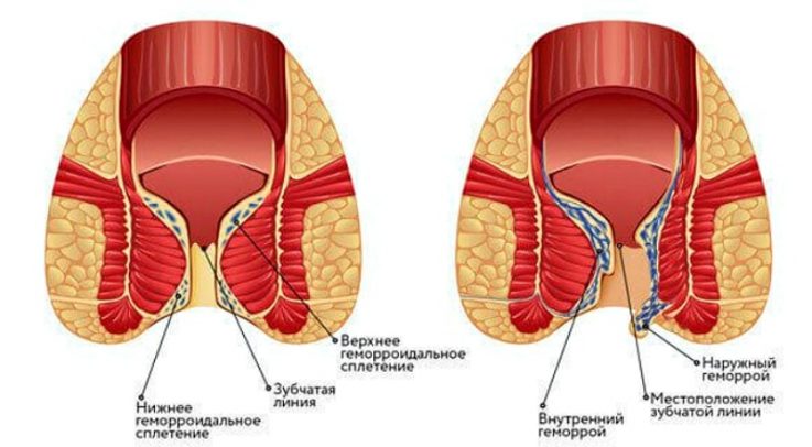 Геморрой