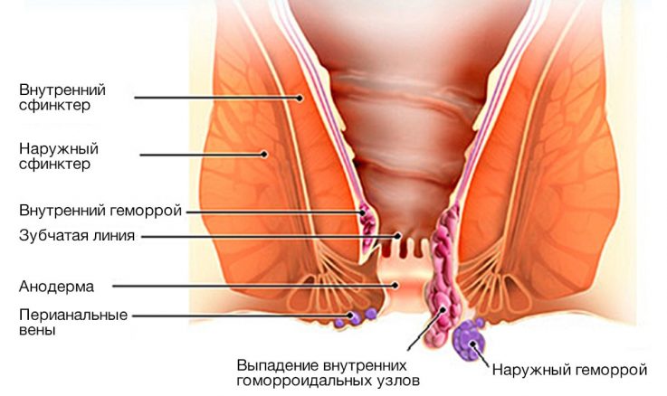 Геморрой при беременности 