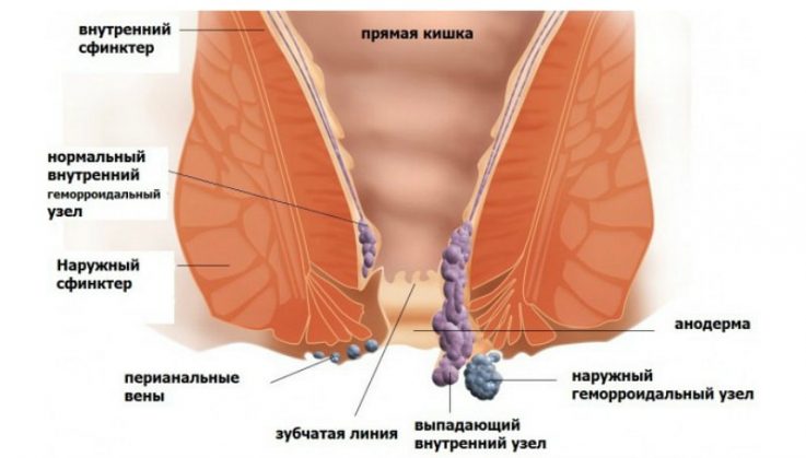 Подушки при геморрое 