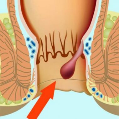 Почему появляется наружный геморрой 