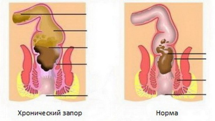 Запоры при геморрое 