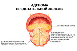 Аденома простаты одна из причин при боли мочеспускании