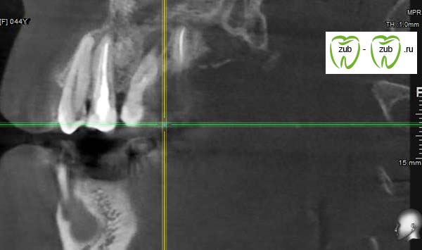 срез 4 КТ мостовидного протеза